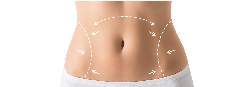 woman's abdomen with arrows illustrating body lift procedure