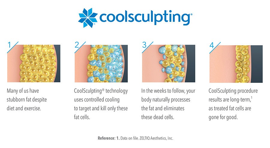 infographic describing how coolsculpting reduces fat