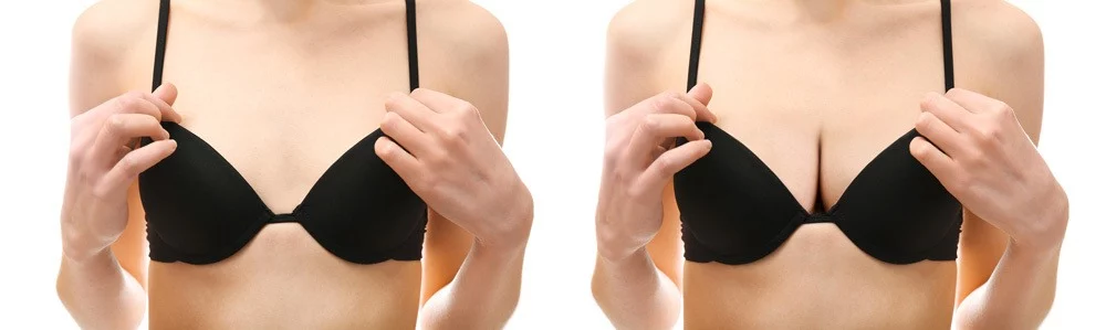 Removal and Replacement of Breast Implants at artemedica in sonoma county