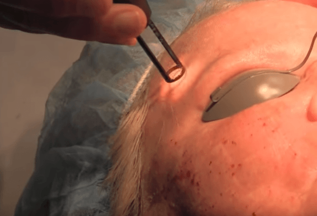 Esthetician using laser facial treatment on client's forehead