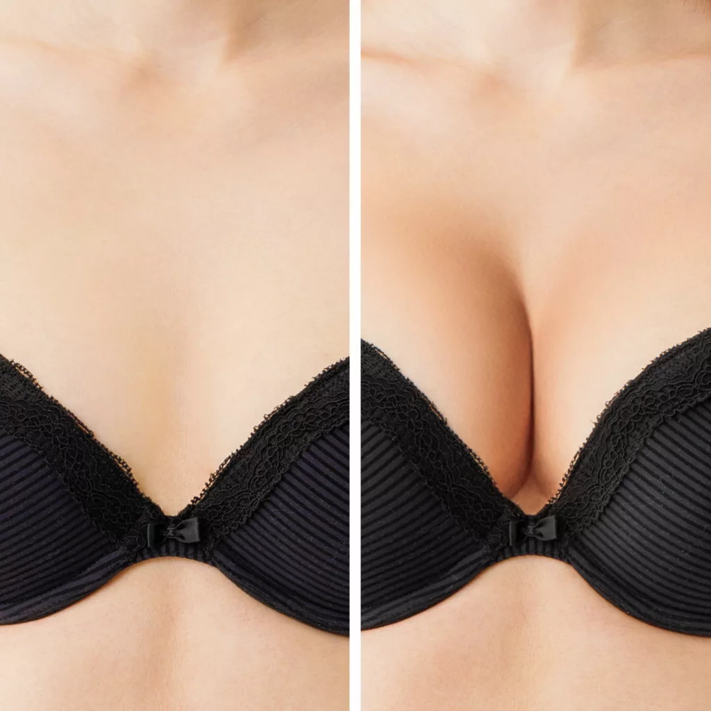 before and after breast augmentation surgery at Artemedica