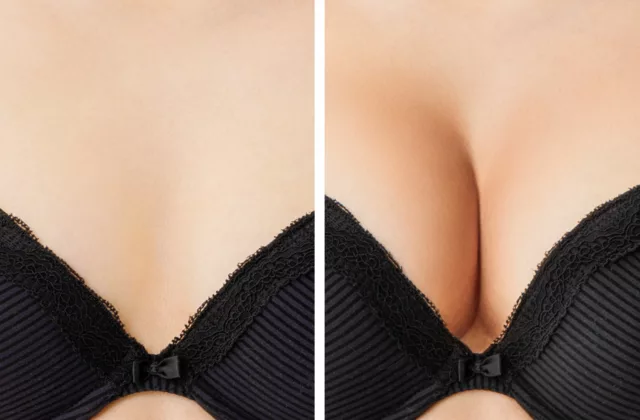 before and after breast augmentation surgery at Artemedica