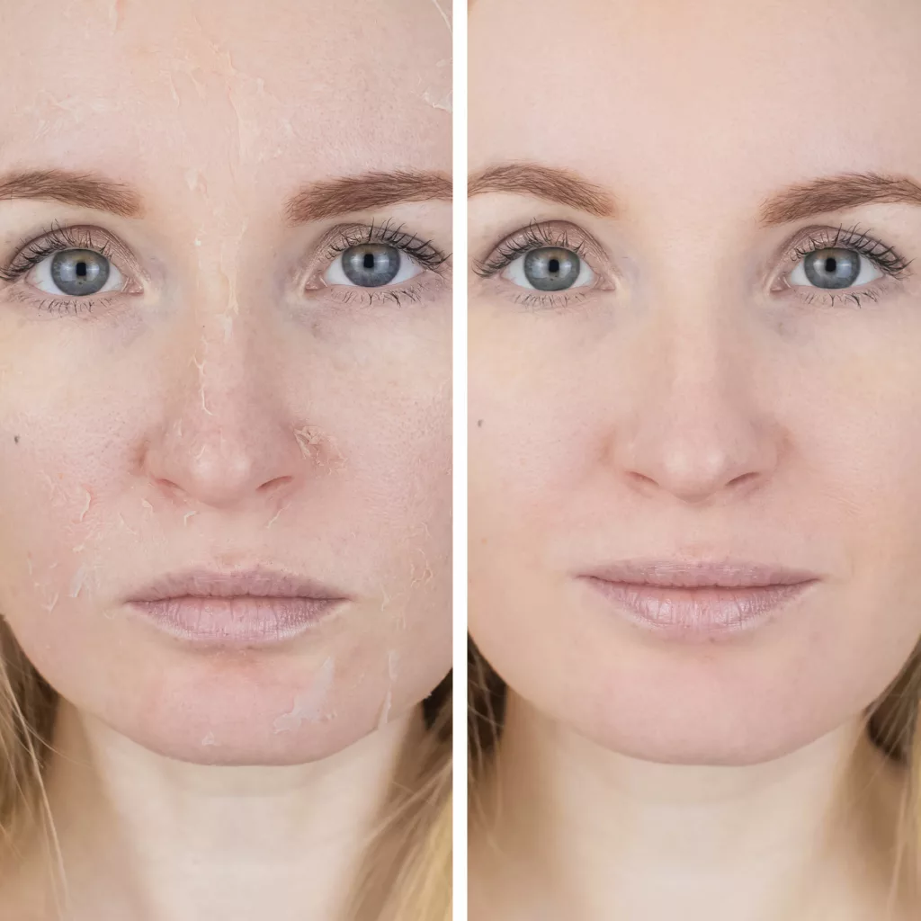 before and after pixel peel at a medical spa