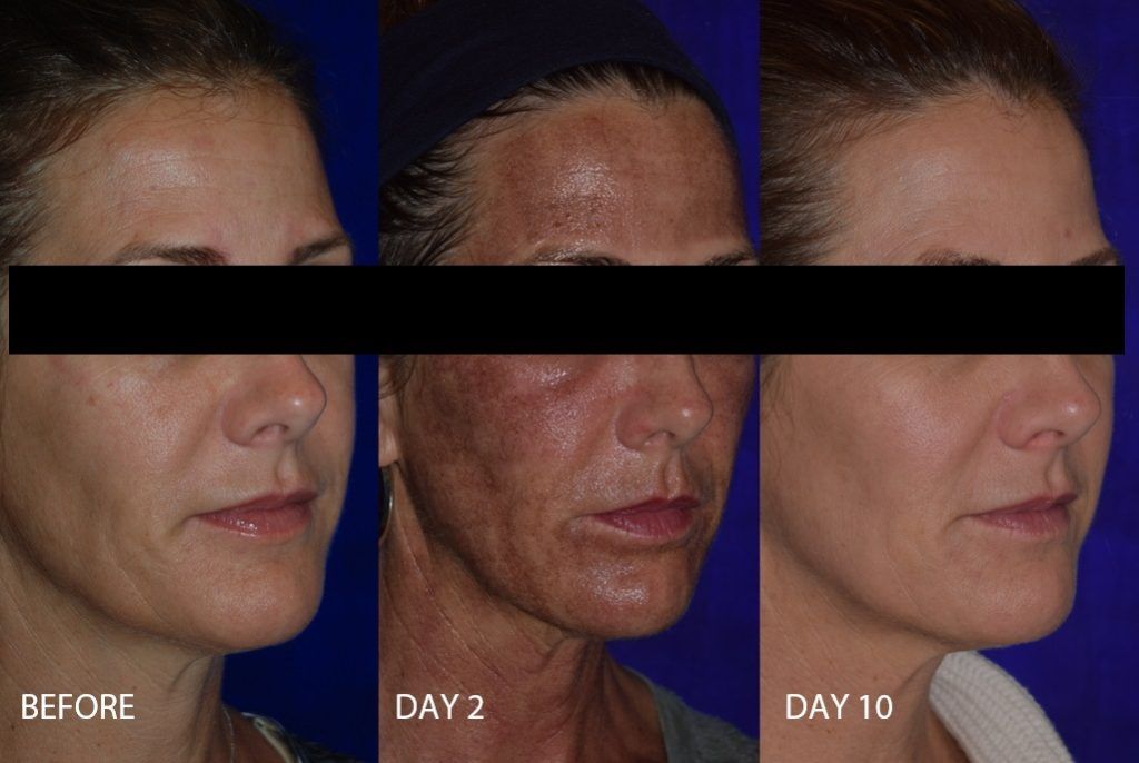 Before and after woman's laser resurfacing treatment showing improved skin tone and texture