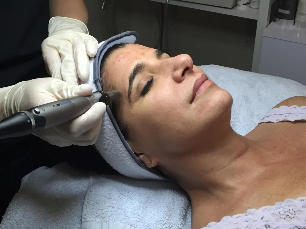 esthetician using pixel peel facial treatment on client's forehead