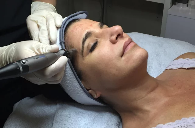esthetician using pixel peel facial treatment on client's forehead