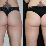 before and after woman's Sculptra Non-Invasive Butt Lift at artemedica in sonoma county