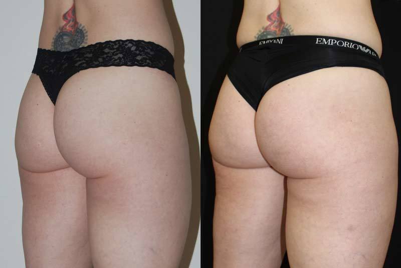 Sculptra non-surgical butt lift - Hush LA Medspa