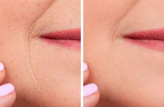 before and after juvederm vollure dermal fillers to smooth out severe laugh lines