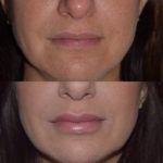Before and after woman's injection of Juvederm vollure xc to enhance lips