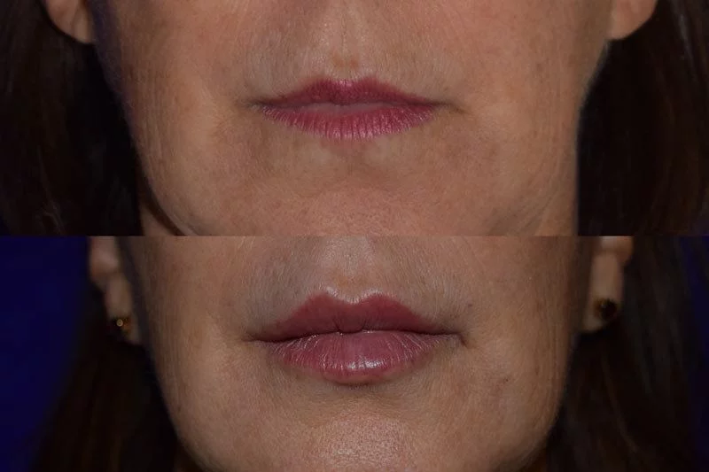 Before and after woman's injection of Juvederm vollure xc to enhance lips