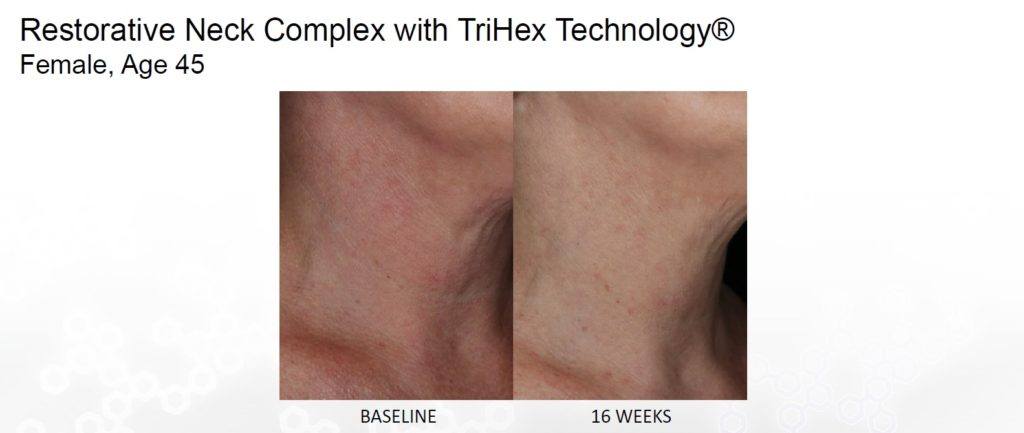 before and after alastin restorative neck complex