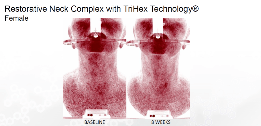 before and after alastin restorative neck complex