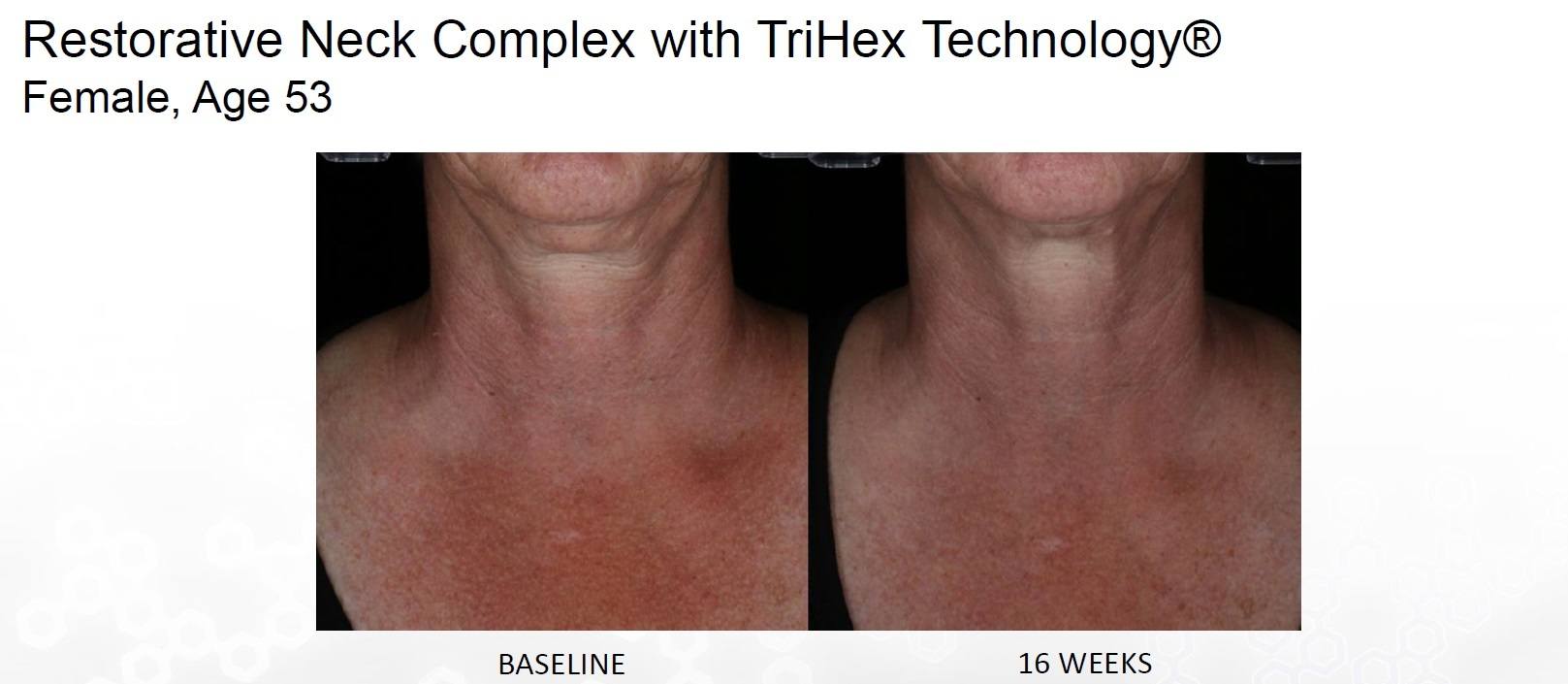 before and after alastin restorative neck complex