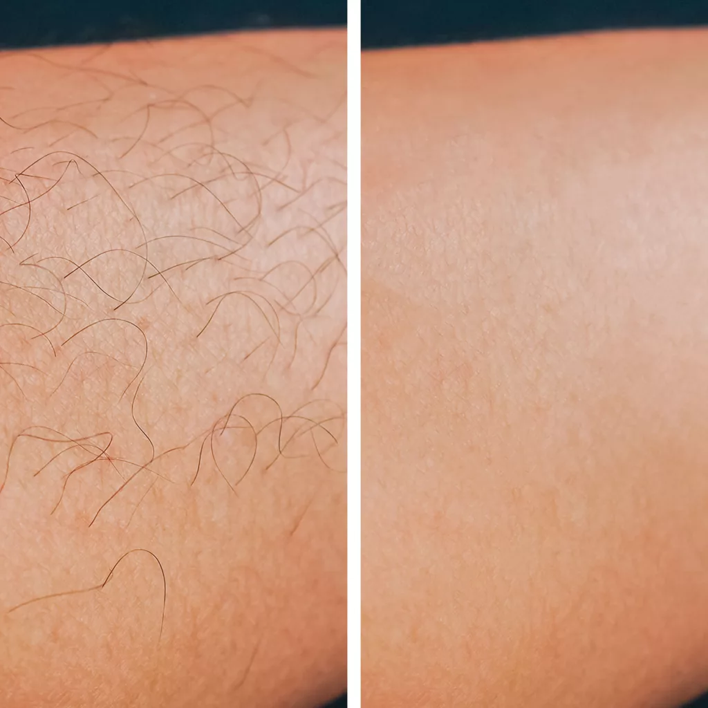 before and after laser hair removal