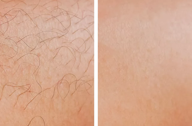 before and after laser hair removal