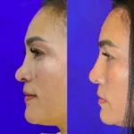 before and after liquid rhinoplasty comparison