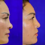 before and after liquid rhinoplasty comparison