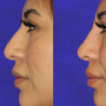 Before and after woman's liquid rhinoplasty to smooth nose contours