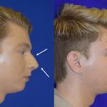 Before and after man's liquid rhinoplasty to improve nose shape