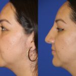 Before and after woman's liquid rhinoplasty to smooth nose contours