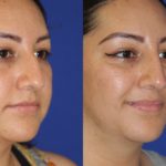 Before and after woman's liquid rhinoplasty to smooth nose contours