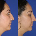 Before and after woman's liquid rhinoplasty to smooth nose contours