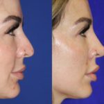 Before and after woman's liquid rhinoplasty to smooth nose contours