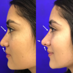 Before and after woman's liquid rhinoplasty to smooth nose contours