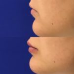 Before and after woman's injection of dermal fillers to enhance lips