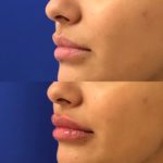 Before and after woman's injection of dermal fillers to enhance lips