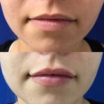 woman's lips before and after lip filler treatment showing improved lip volume and shape