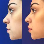 side profile of woman's lips before and after lip filler treatment showing improved lip volume and shape