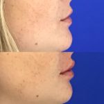 Before and after woman's injection of dermal fillers to enhance lips