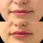 Before and after woman's injection of dermal fillers to enhance lips