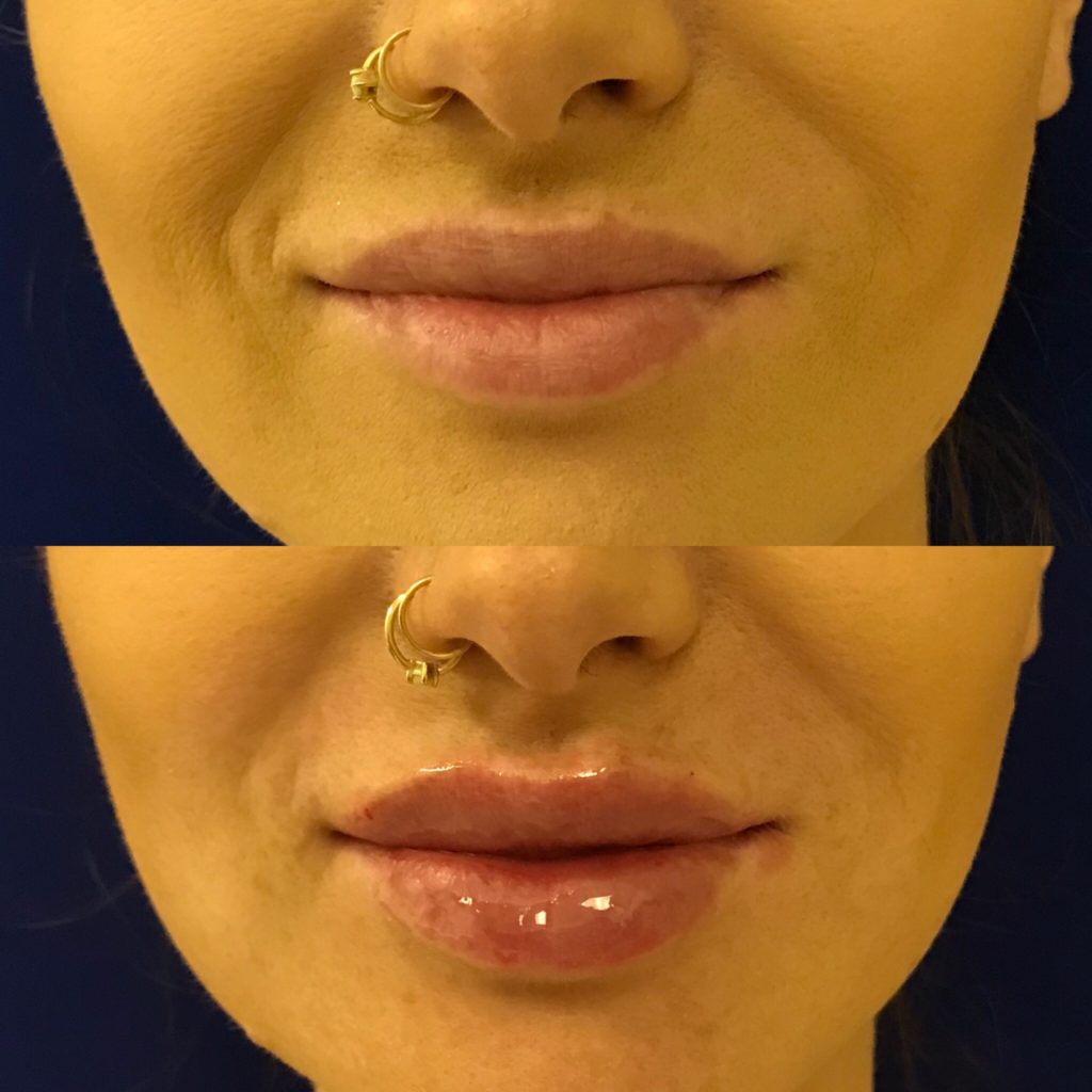 side by side before and after photos of lip filler treatment
