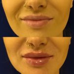woman's lips before and after lip filler treatment showing improved lip shape and volume
