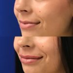 Before and after woman's injection of dermal fillers to enhance lips