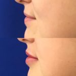 Before and after woman's injection of dermal fillers to enhance lips