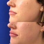 Before and after woman's injection of Juvederm to enhance lips