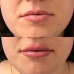 Before and after woman's injection of Juvederm to enhance lips