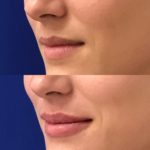 Before and after woman's injection of Juvederm to enhance lips