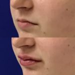 Before and after woman's injection of Juvederm to enhance lips