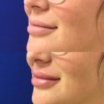 Before and after woman's injection of Juvederm to enhance lips