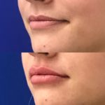 Before and after woman's injection of Juvederm to enhance lips