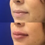 Before and after woman's injection of Juvederm to enhance lips