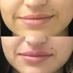 Before and after woman's injection of Juvederm to enhance lips