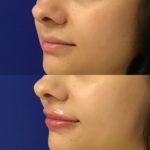 Before and after woman's injection of Juvederm to enhance lips