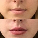 Before and after woman's injection of dermal fillers to enhance lips