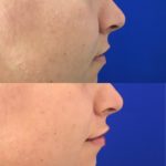 side profile of woman's lips before and after lip filler treatment showing improved lip volume and shape
